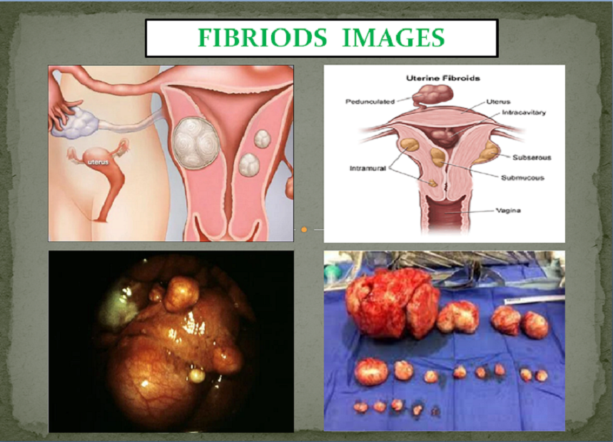 Fibroid Pack