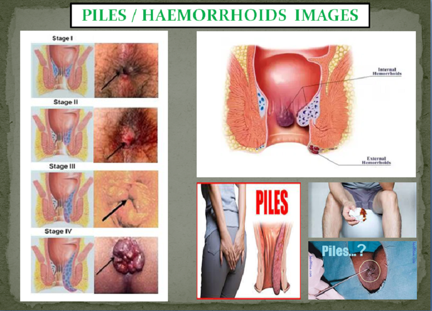 Symptoms of Piles in Female - Images, Reasons and Treatment