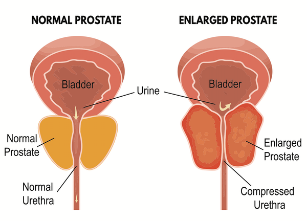 Prostate Enlargement Pack