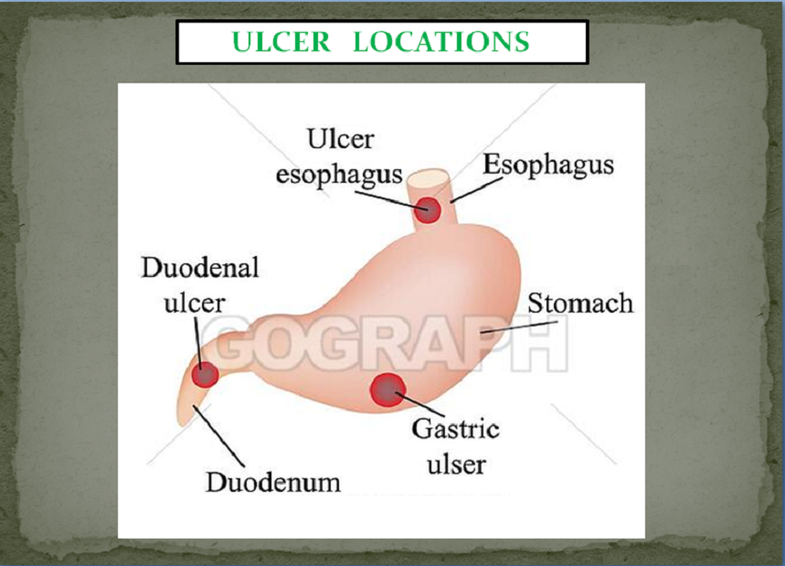 Ulcers Package